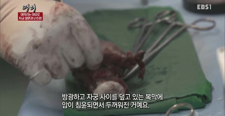 난소암은 정말 무서운 암입니다.jpg | 인스티즈