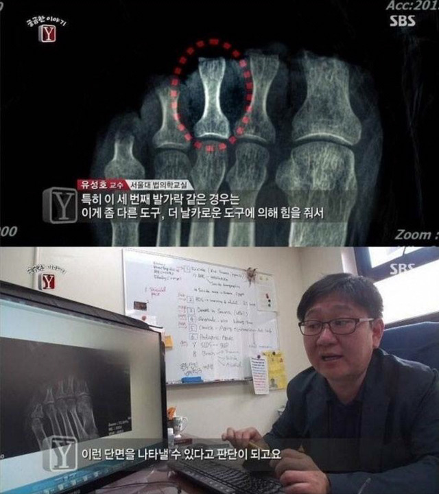 자고 일어나니 발가락이 모두 사라진 남자 | 인스티즈