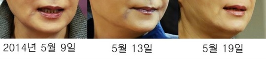 헬반도의 흔한 시술 중독자 | 인스티즈