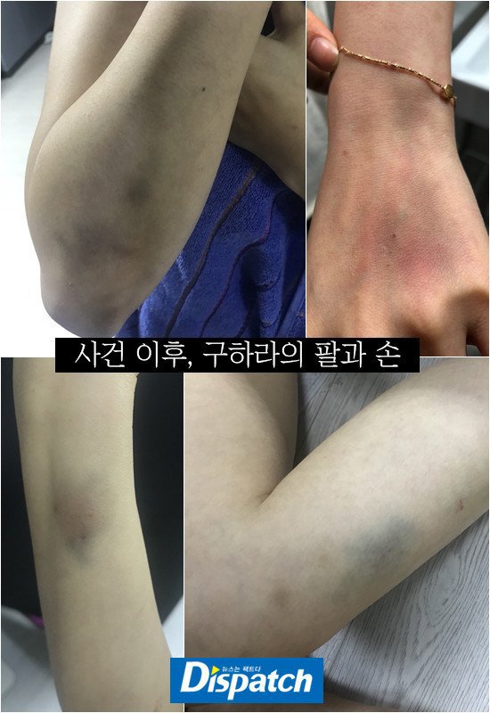 구하라 디스패치 멍든 사진 | 인스티즈