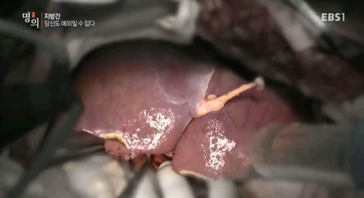 말기 간경변 환자의 간.jpg (사진주의) | 인스티즈